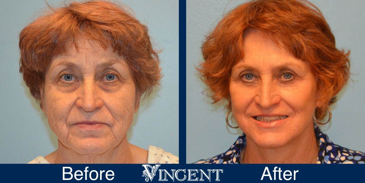 utah facelift before and after female