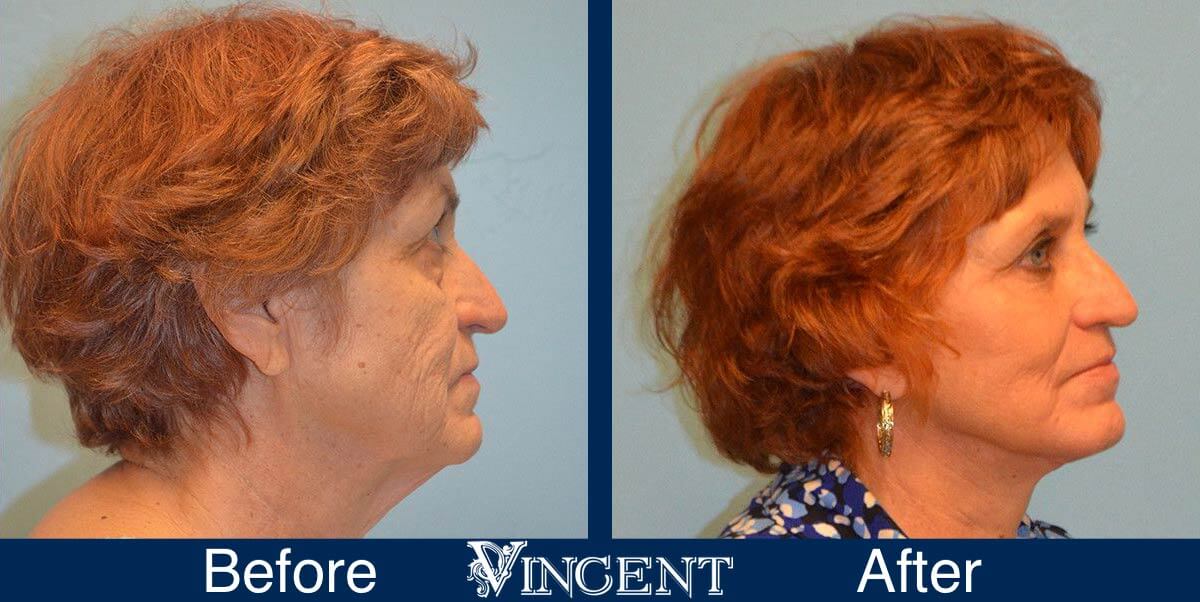 utah facelift before and after female
