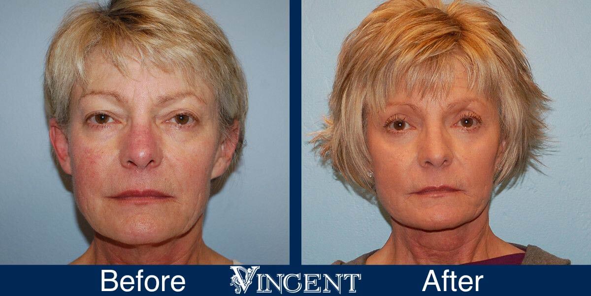 utah facelift before and after female