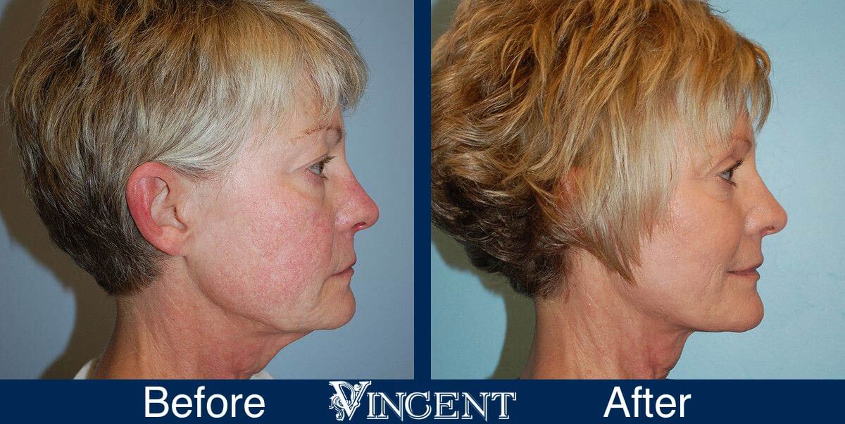 utah facelift before and after female