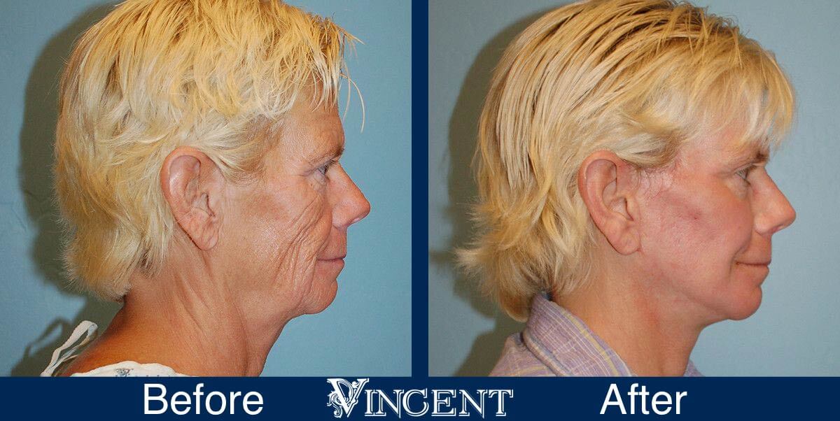 utah facelift before and after female