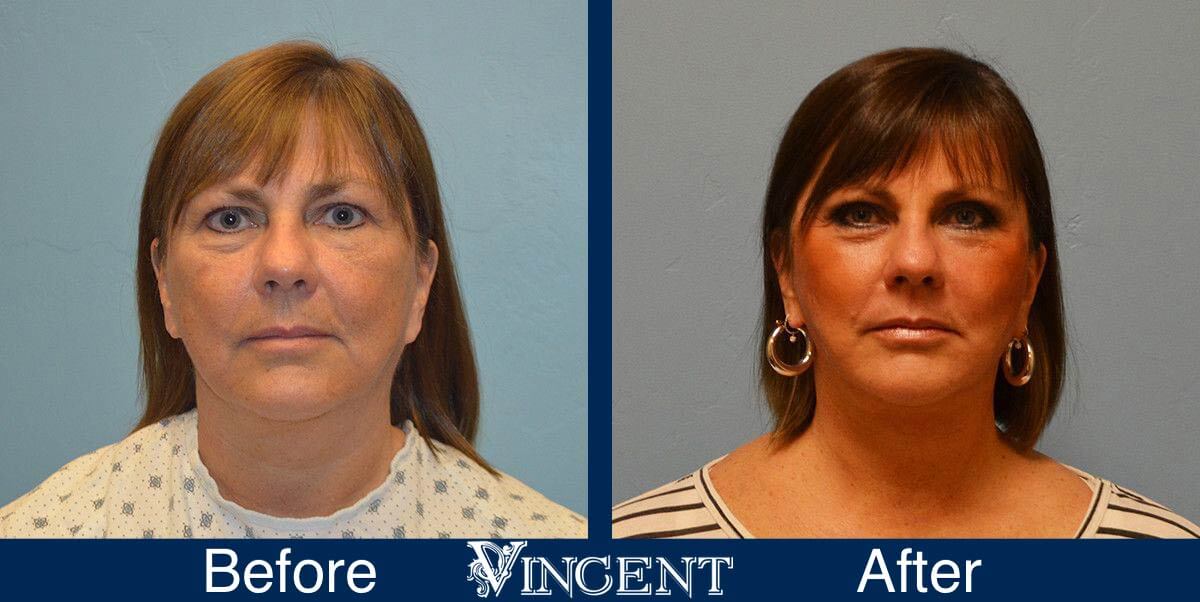 utah facelift before and after female