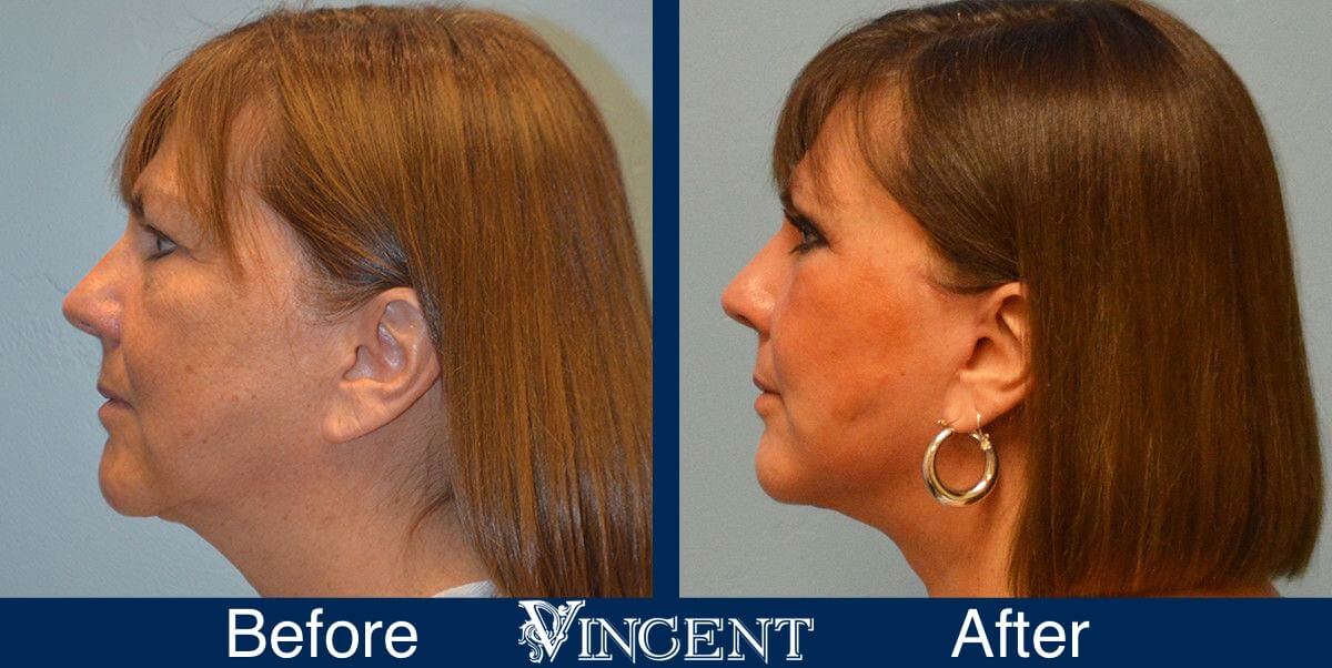 utah facelift before and after female