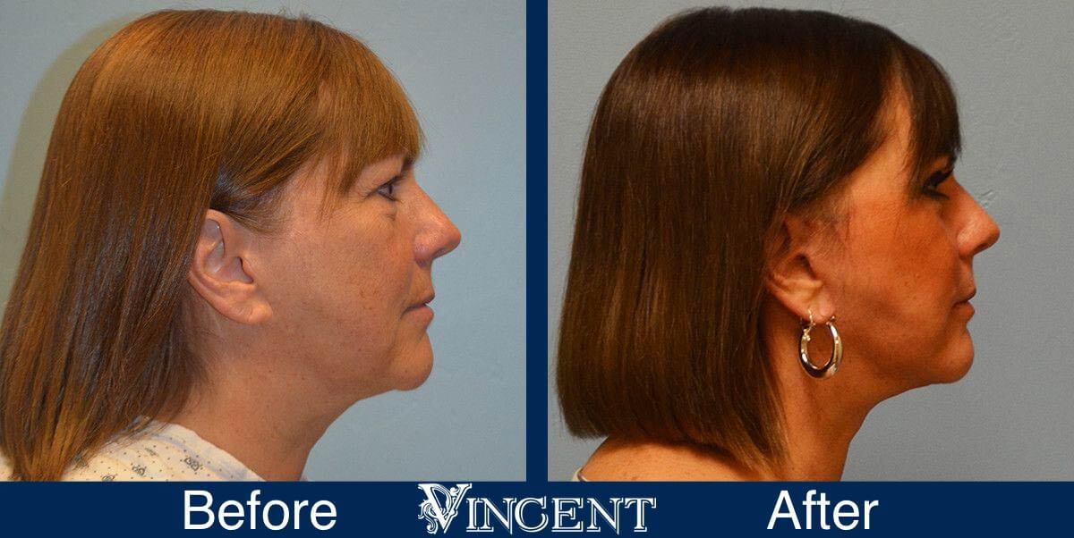 utah facelift before and after female