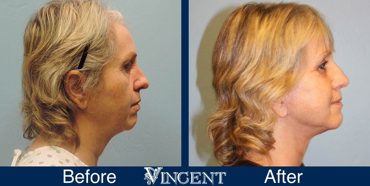 utah facelift before and after female