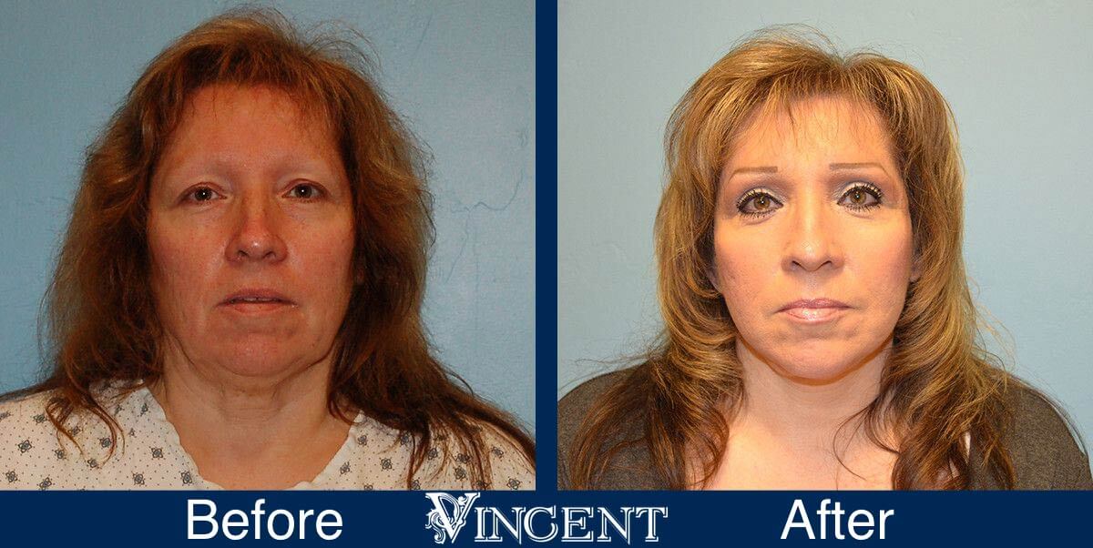 utah facelift before and after female