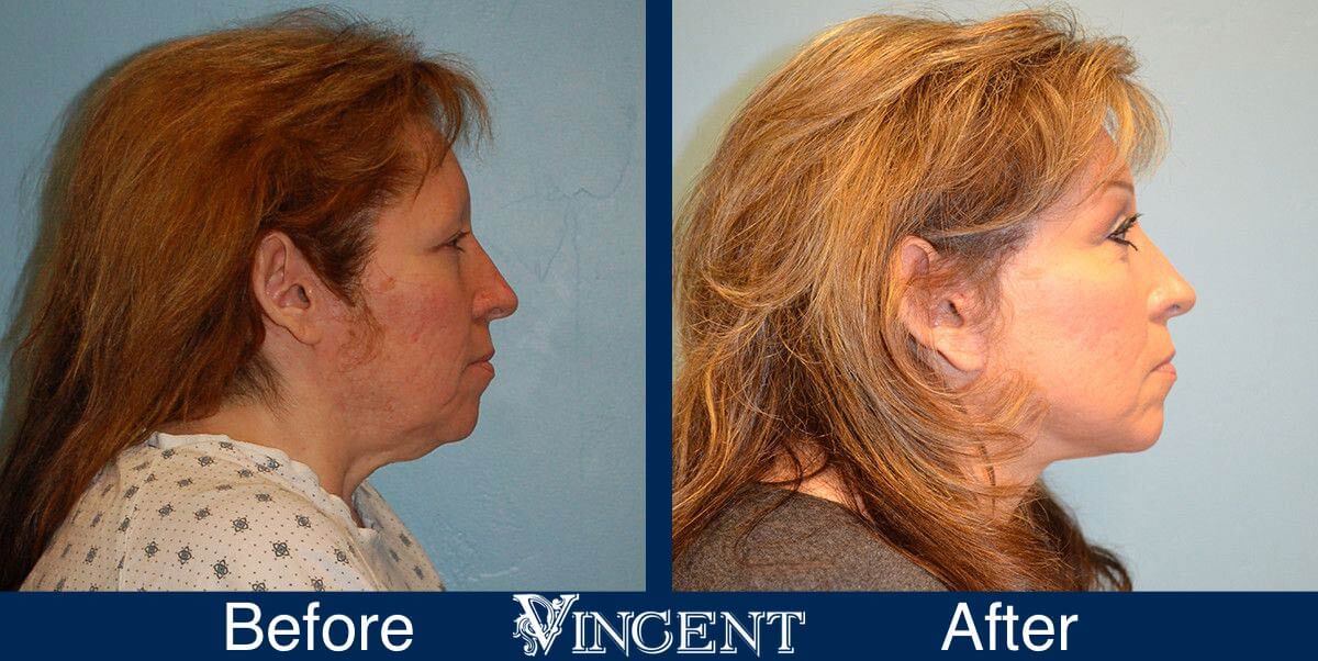 utah facelift before and after female