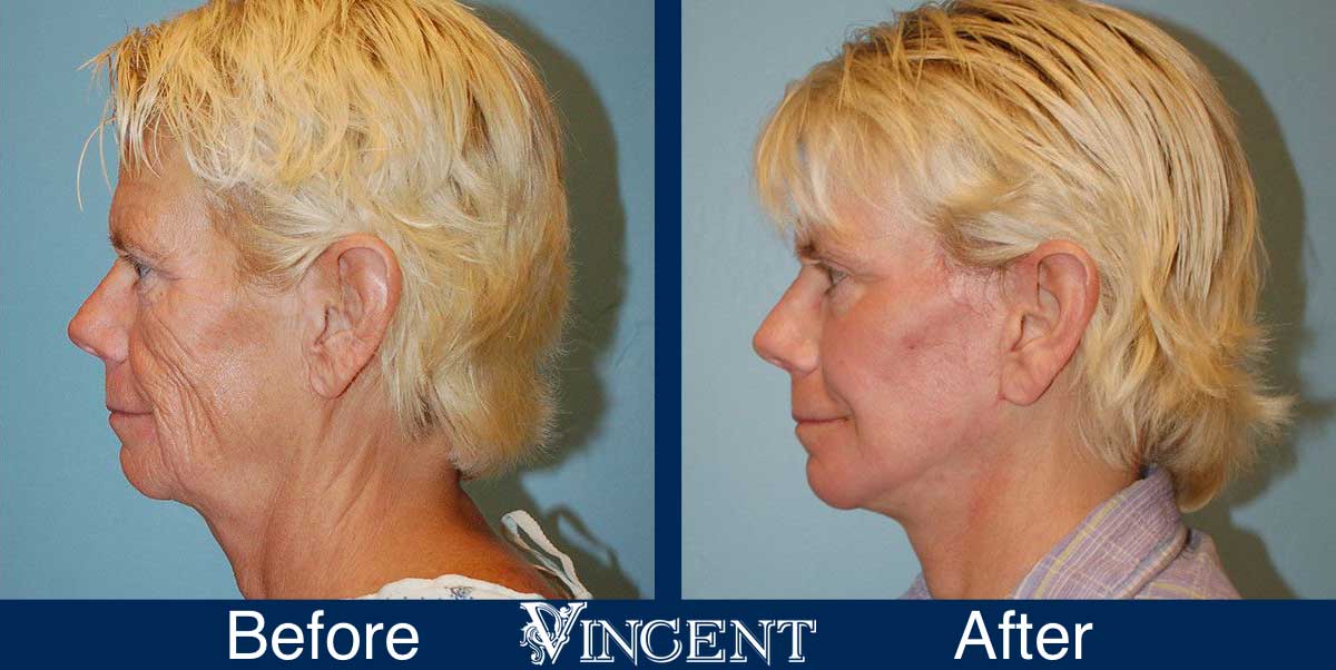 co2 laser treatment before and after utah