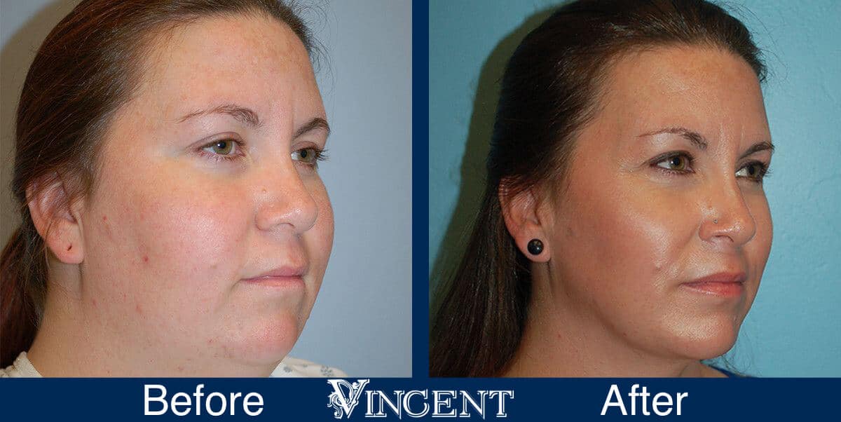 Chin Liposuction Before and After Photos 1