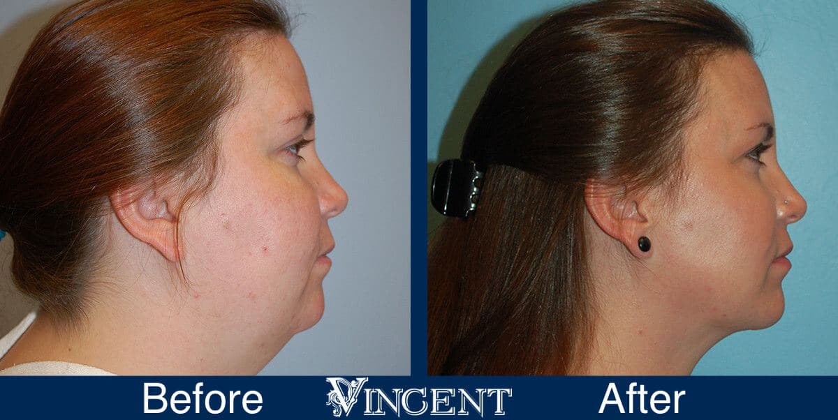 Chin Liposuction Before and After Photos 2