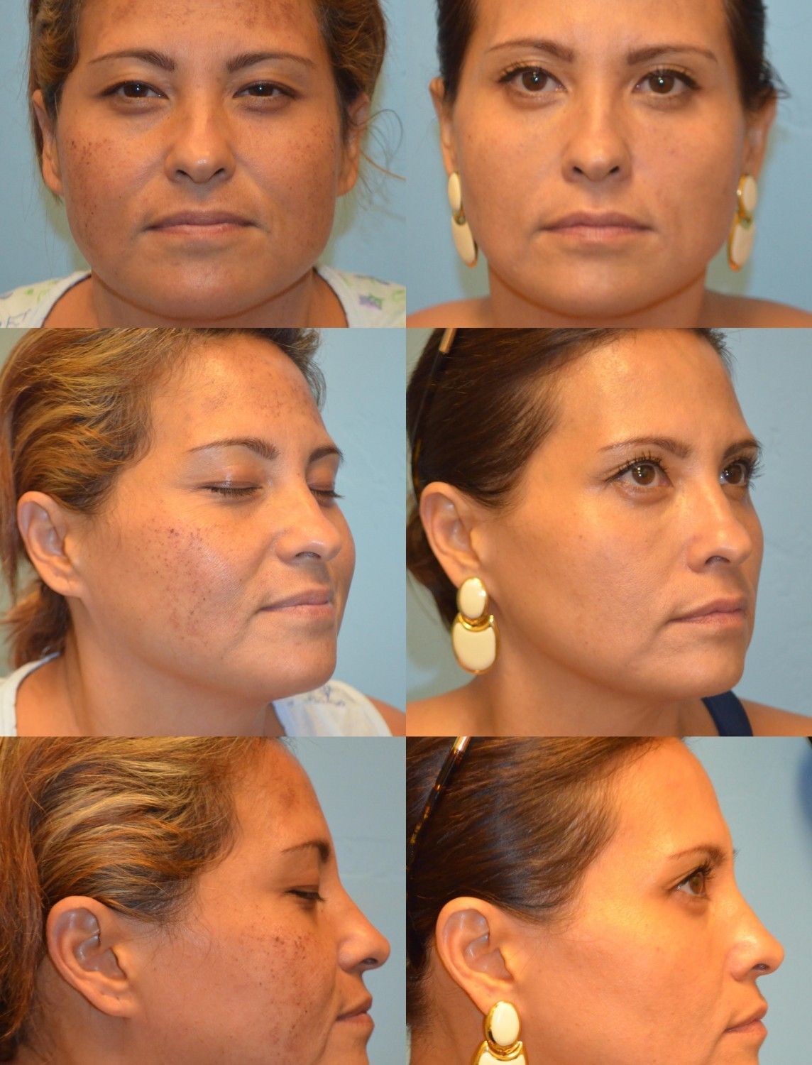 IPL Photofacial Before and After Photos 1