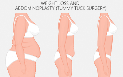 What Makes Someone a Good Candidate for a Tummy Tuck?